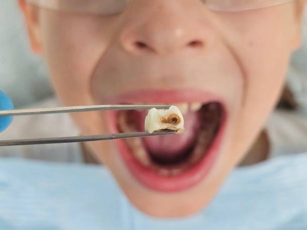 Best Emergency Treatment for Dental Infections or Abscesses in Loxley, AL